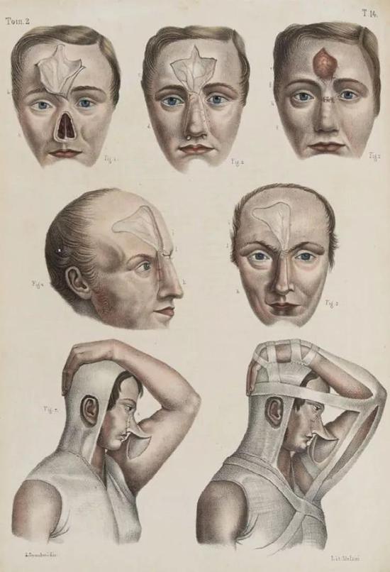  áյ˹ˡJean Baptiste Marc Bourgery˹ŸNicholas Henri JacobġƽѧӰѧIconografia danatomia chirurgica e di medicina operatoria1841ꡣͼԴPinterest